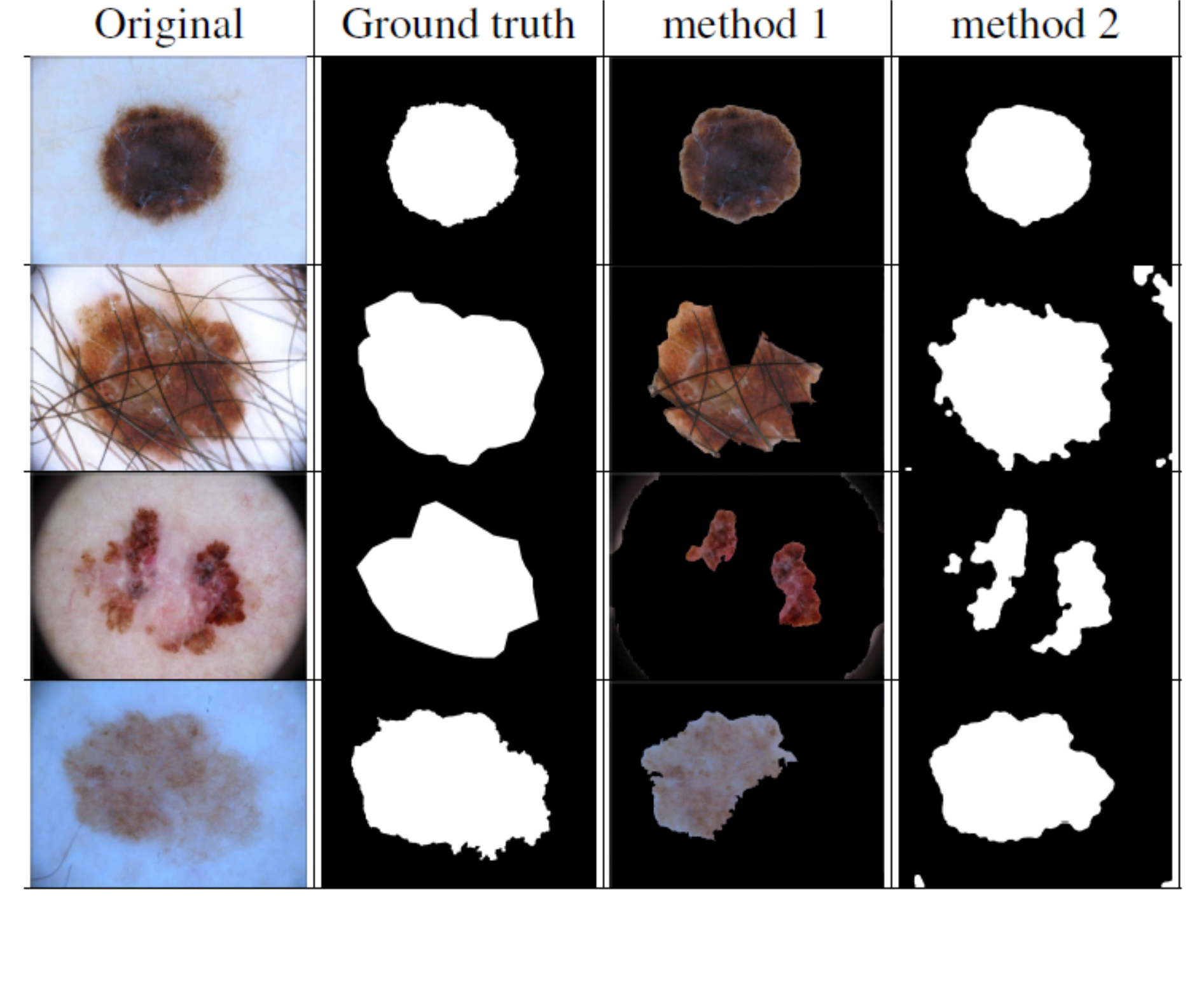 Comparative Analysis Of Automatic Skin Lesion Segmentation With Two ...